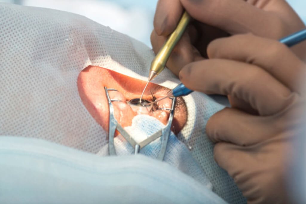 Retina Surgery